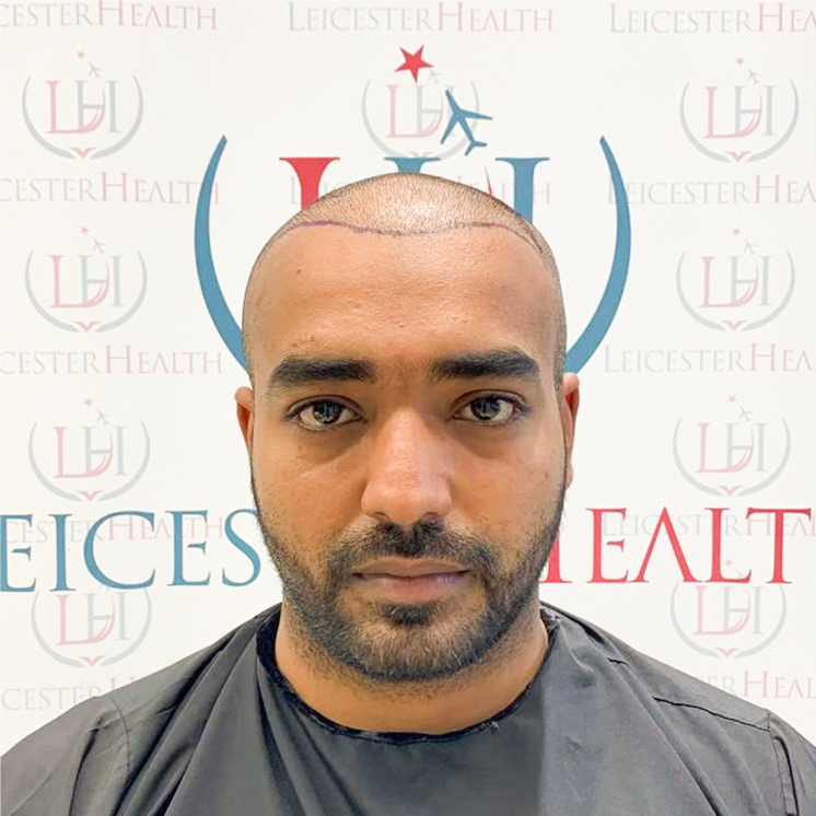 Ein Foto von vorne von dem Patienten, der in Rüsselsheim in die Klinik für Haartransplantation gegangen ist, wo ihm vor dem Eingriff der Kopf markiert wurde