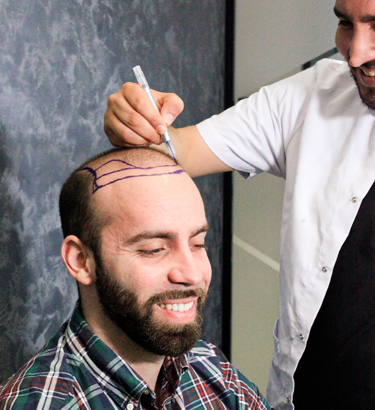 Der Patient, dessen Kopf für eine Haartransplantation markiert ist, steht neben dem Arzt, und sie lächeln.