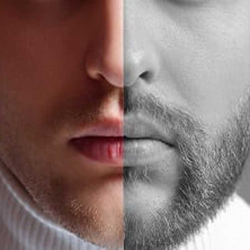 Das vorherige und nachherige Aussehen des Mannes nach einem Barttransplantation