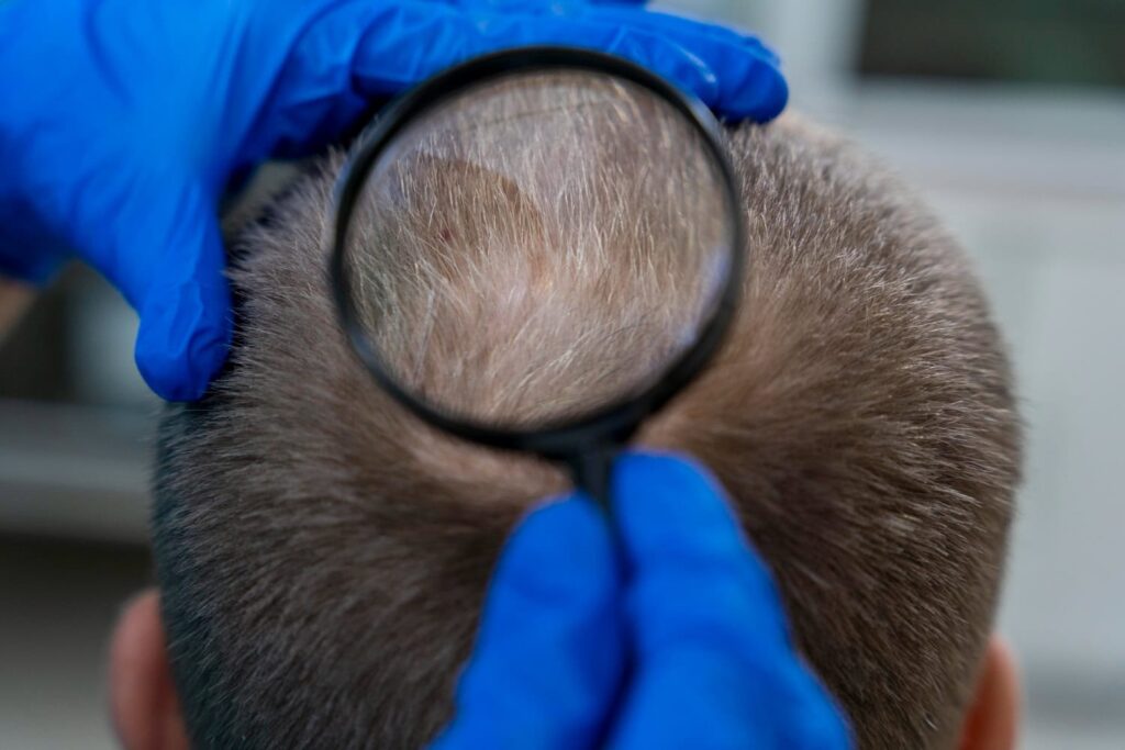 DHI und FUE Haartransplantationsmethoden im Vergleich.