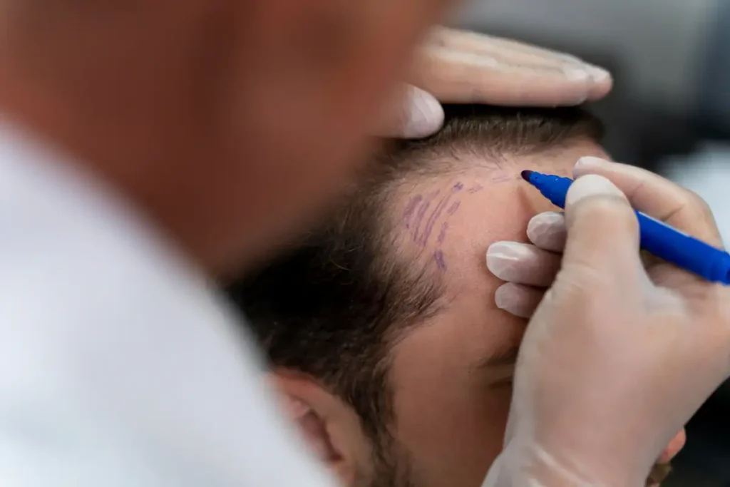 Ein Patient, dem vor der Haartransplantation eine Kopfzeichnung angefertigt wird.