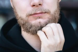 Ein junger Mann mit gelbem Bart, der unter Bartflechte leidet.