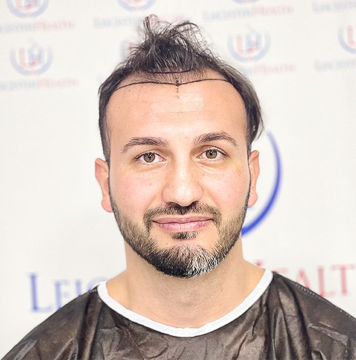 der-patient-dessen-kopfhaut-fur-die-haartransplantation-markiert-wurde-wartet-in-der-haarklinik-russelsheim-leicester