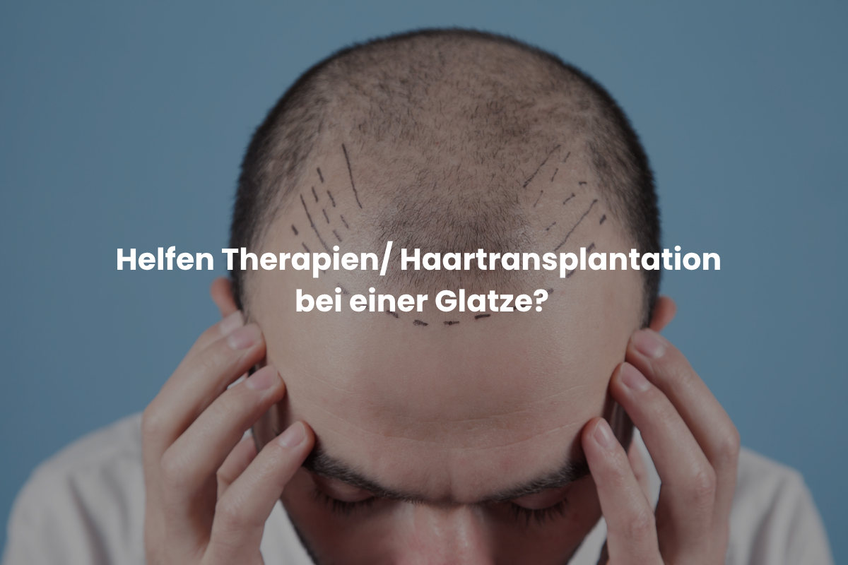Helfen Therapien Haartransplantation bei einer Glatze