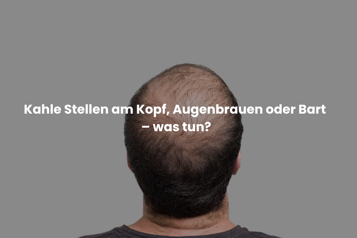 Kahle Stellen am Kopf, Augenbrauen oder Bart – was tun