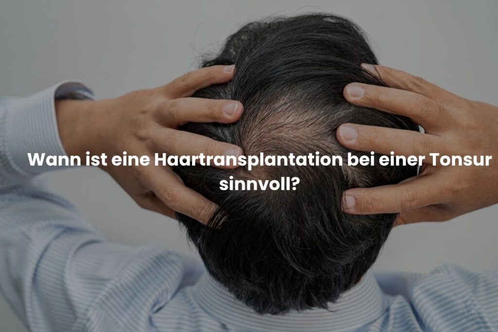 Wann ist eine Haartransplantation bei einer Tonsur sinnvoll