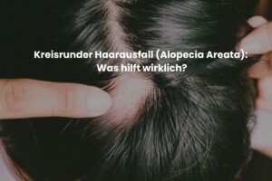 Kreisrunder Haarausfall (Alopecia Areata): Was hilft wirklich?