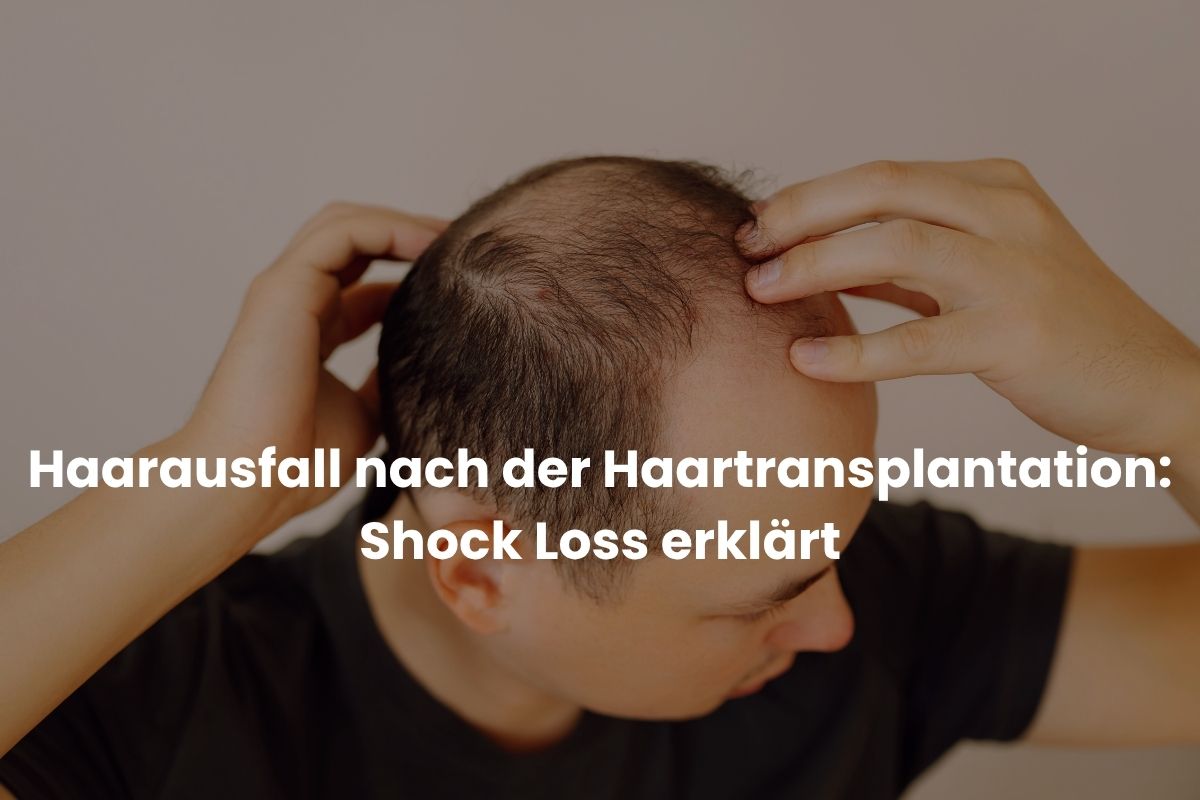 Haarausfall nach der Haartransplantation: Shock Loss erklärt