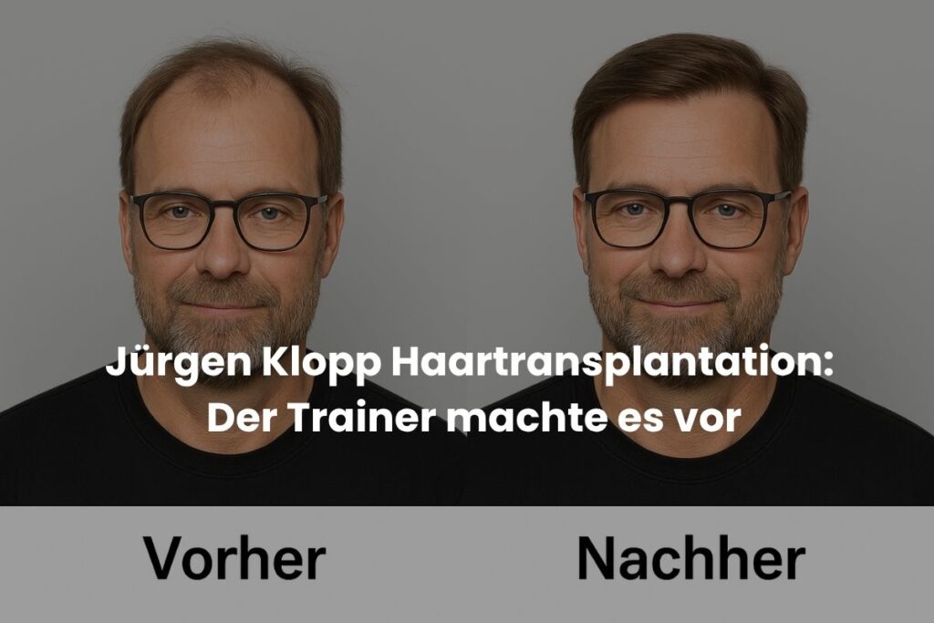 Jürgen Klopp Haartransplantation: Der Trainer machte es vor
