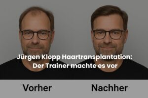 Jürgen Klopp Haartransplantation: Der Trainer machte es vor