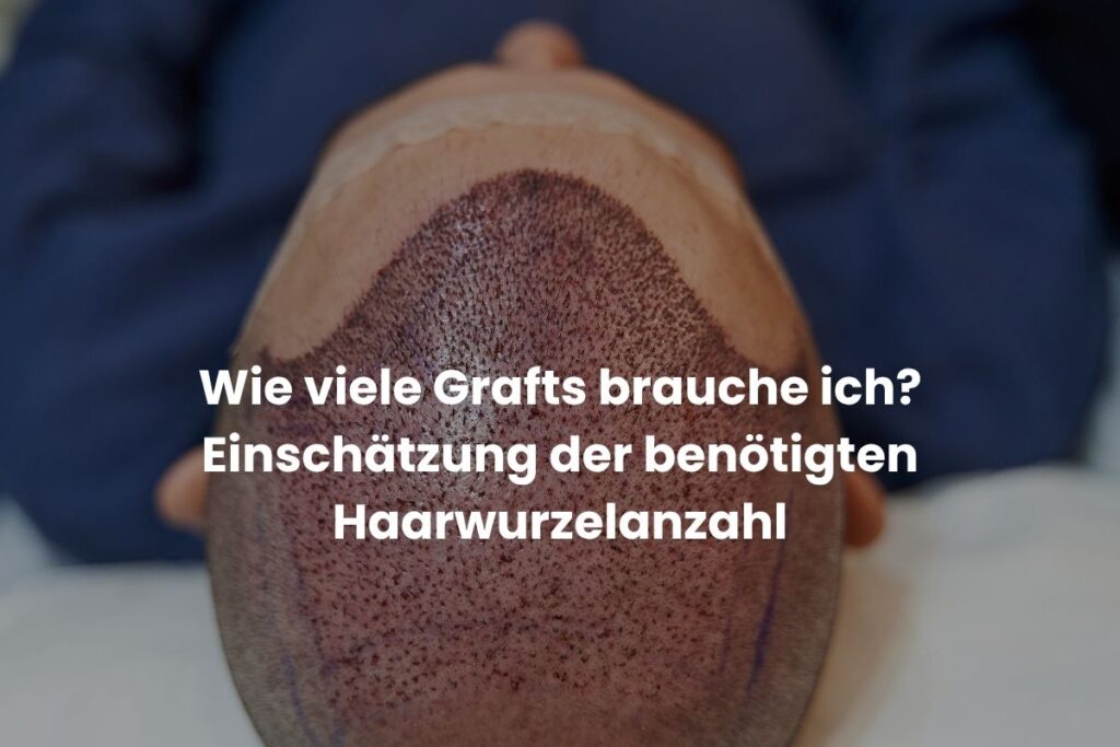 Wie viele Grafts brauche ich? Einschätzung der benötigten Haarwurzelanzahl