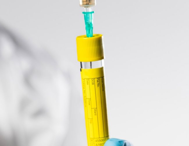 vor-der-prp-behandlung-wird-flussigkeit-aus-der-vorbereiteten-mischung-mit-einer-spritze-entnommen